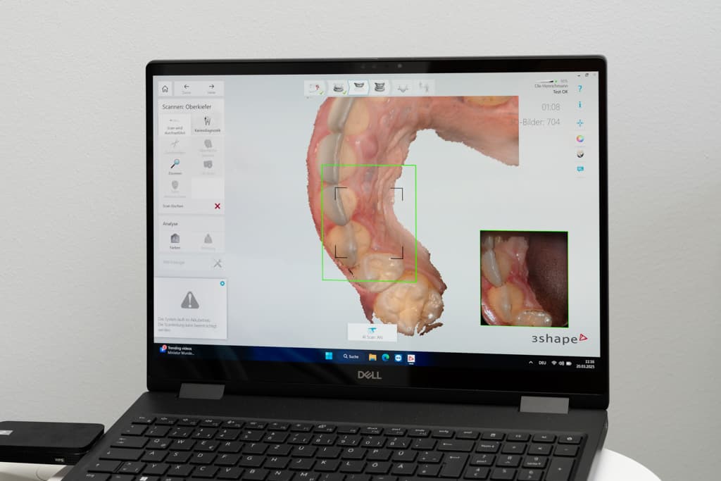 Intraoralscanner im Einsatz